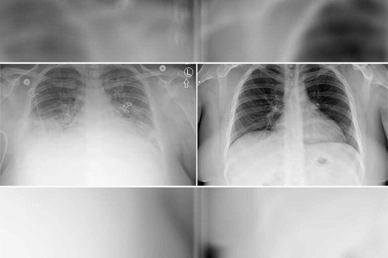 À gauche, vous pouvez voir le scanner des poumons d'un patient atteint de la maladie respiratoire associée au vapotage, tandis qu'à droite, vous avez le scanner des poumons du même patient après avoir suivi un traitement. Ces images sont fournies par l'Université de l'Utah.