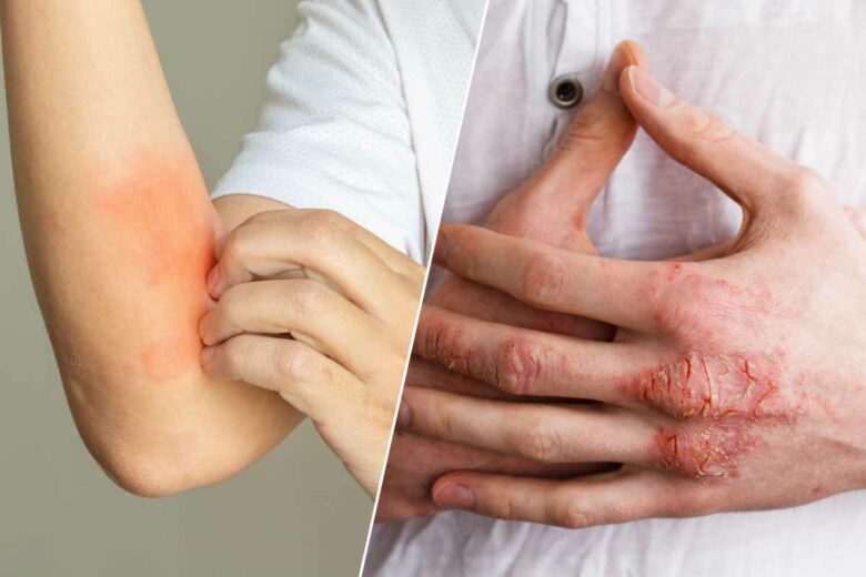 L'eczéma est une maladie de peau tres fréquente et il existe peu de solutions pour lutter contre les démangeaisons.
