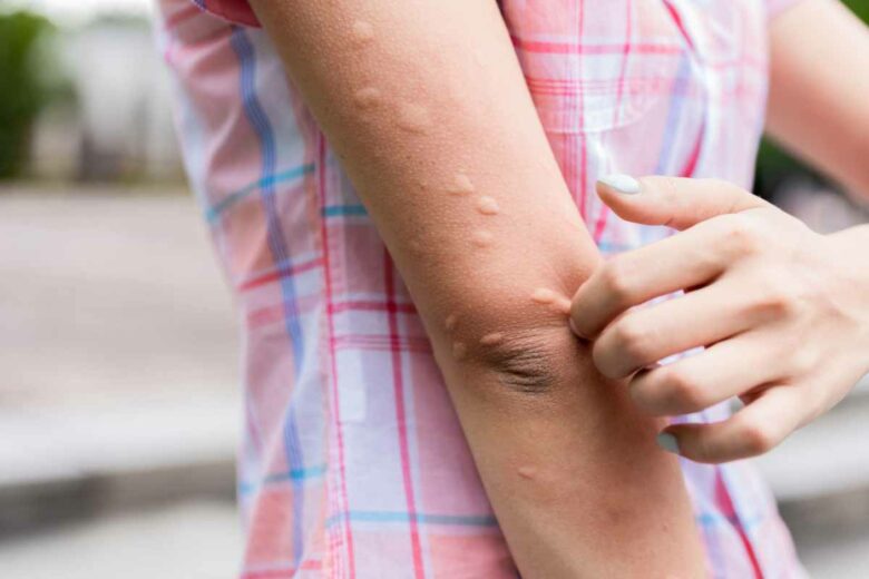 Le bras d'une jeune femme recouvert de piqures de moustiques.