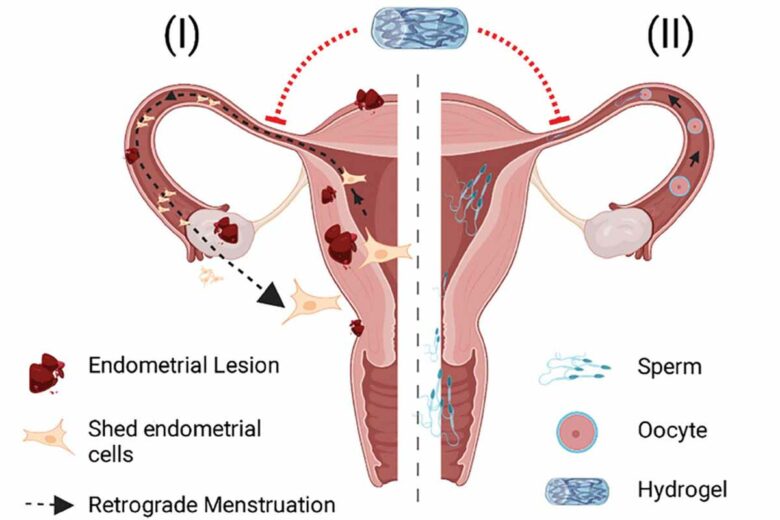 Illustration d'une occlusion fonctionnelle des trompes de Fallope ayant deux objectifs principaux. (I) Protection contre l'endométriose en empêchant les menstruations rétrogrades. (II) Contraception par occlusion fonctionnelle par le système d'hydrogel évitant le passage des spermatozoïdes et des ovocytes par les trompes de Fallope et empêchant la fécondation.