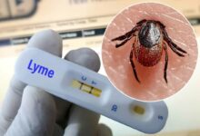 Êtes-vous porteur de la maladie de Lyme sans le savoir ?